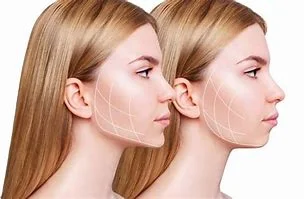 Çene / Jawline Dolgusu