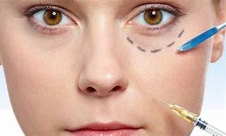 Göz Altı Işık Dolgusu / Tear Through Filler